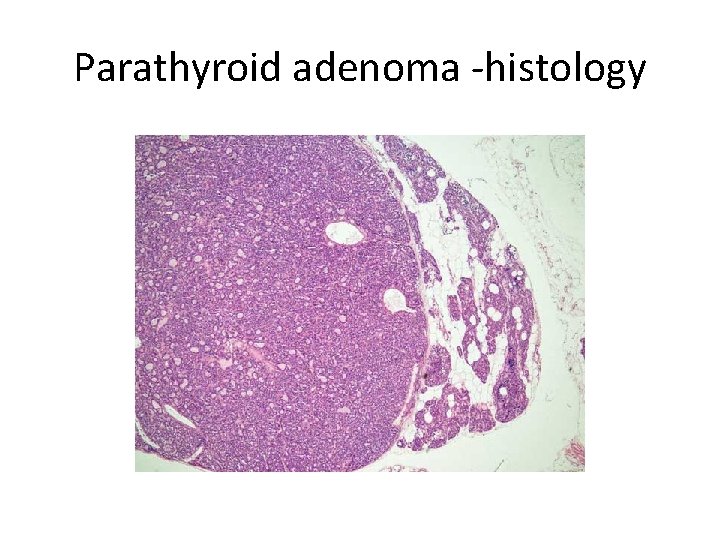 Parathyroid adenoma -histology 