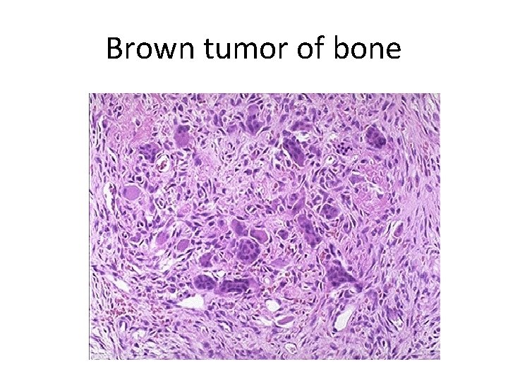 Brown tumor of bone 