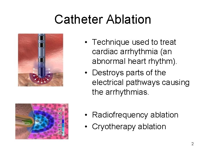 Catheter Ablation • Technique used to treat cardiac arrhythmia (an abnormal heart rhythm). •