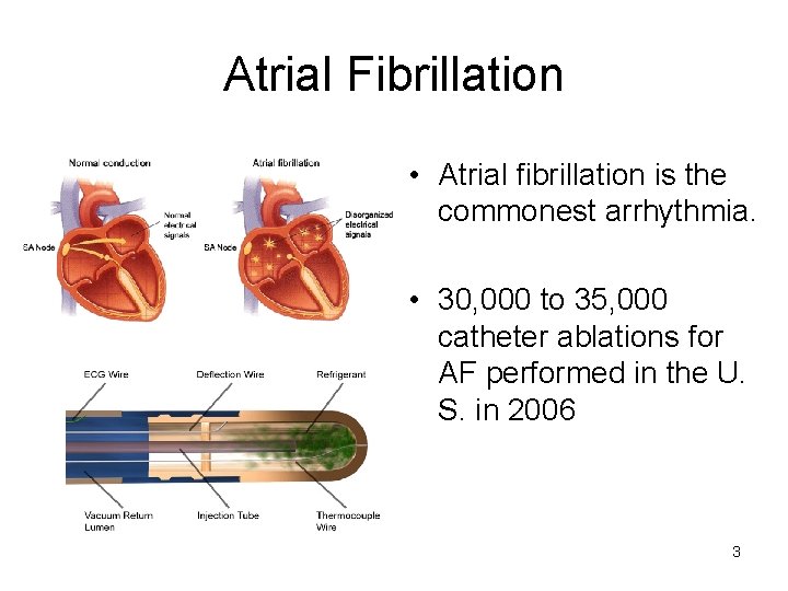 Atrial Fibrillation • Atrial fibrillation is the commonest arrhythmia. • 30, 000 to 35,