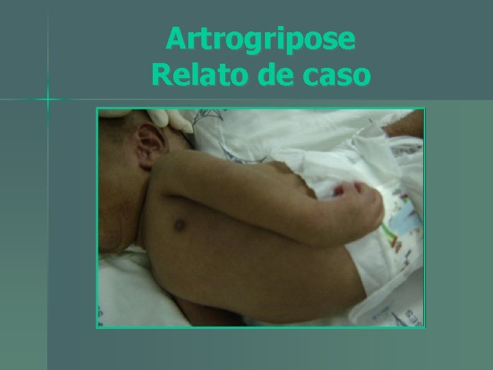 Artrogripose Relato de caso 