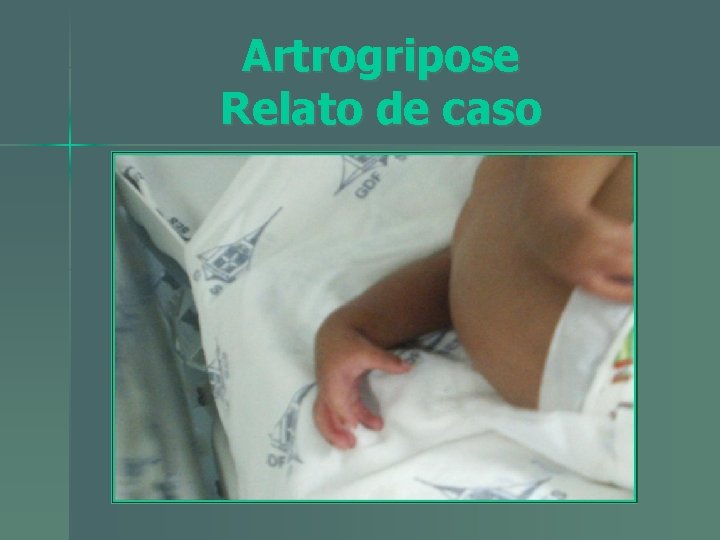 Artrogripose Relato de caso 