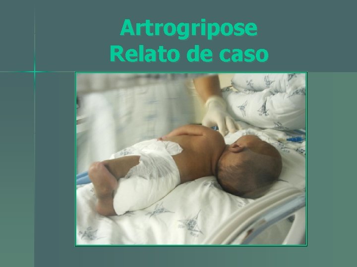 Artrogripose Relato de caso 