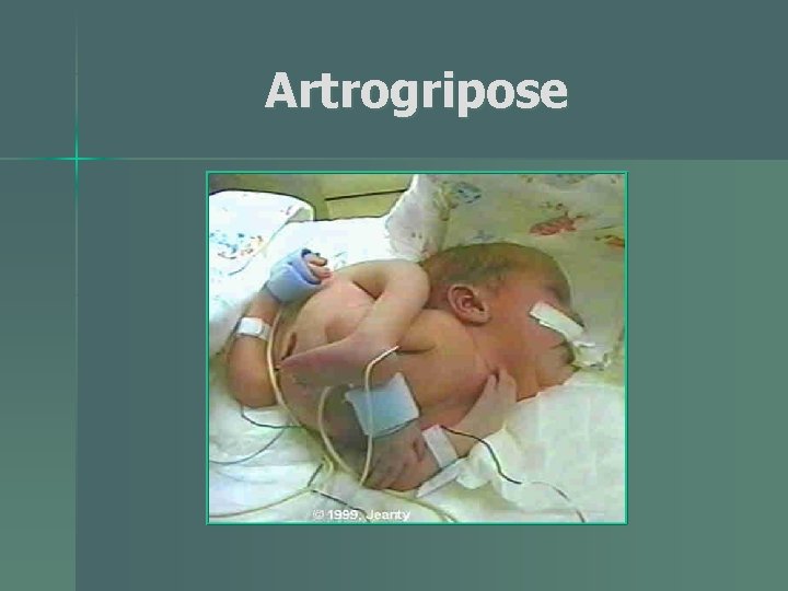 Artrogripose 