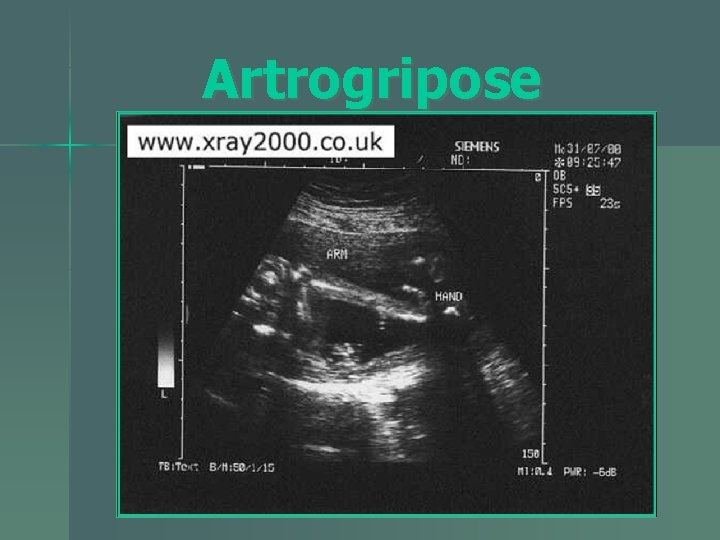 Artrogripose 