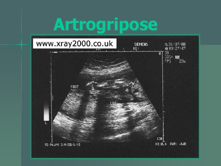 Artrogripose 