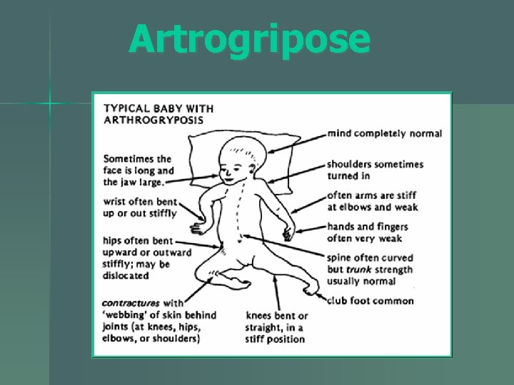 Artrogripose 