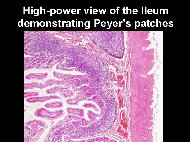 High-power view of the Ileum demonstrating Peyer’s patches 