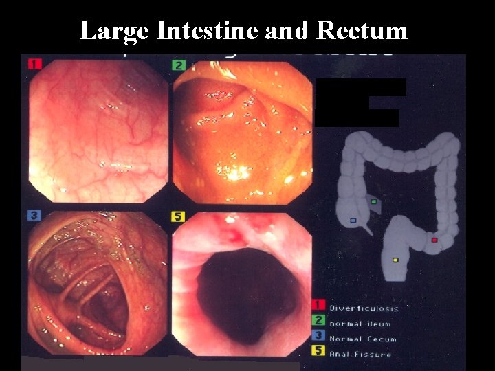 Large Intestine and Rectum 