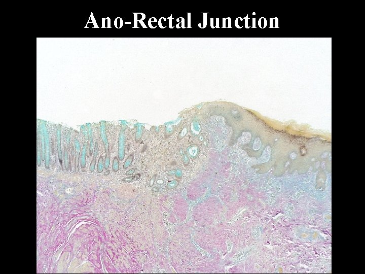 Ano-Rectal Junction 