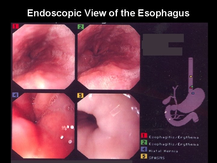 Endoscopic View of the Esophagus 