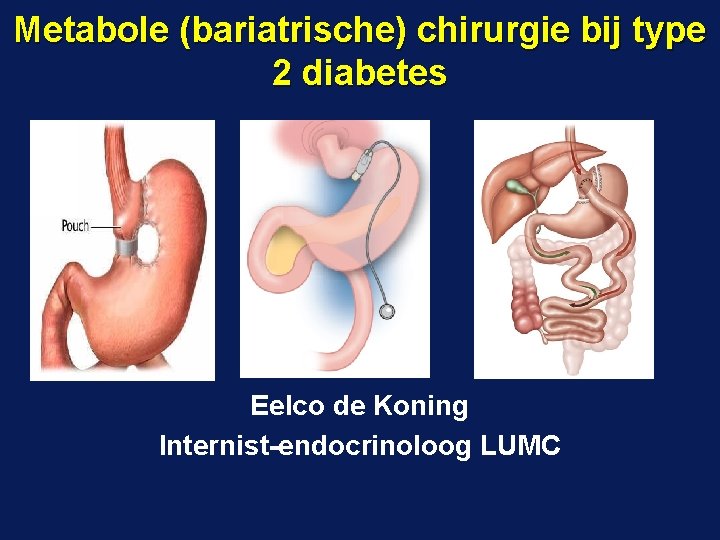 Metabole (bariatrische) chirurgie bij type 2 diabetes Eelco de Koning Internist-endocrinoloog LUMC 