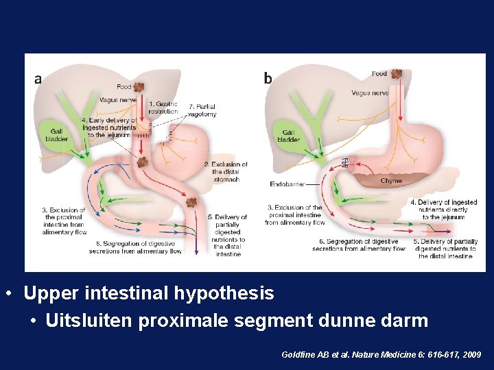  • Upper intestinal hypothesis • Uitsluiten proximale segment dunne darm Goldfine AB et