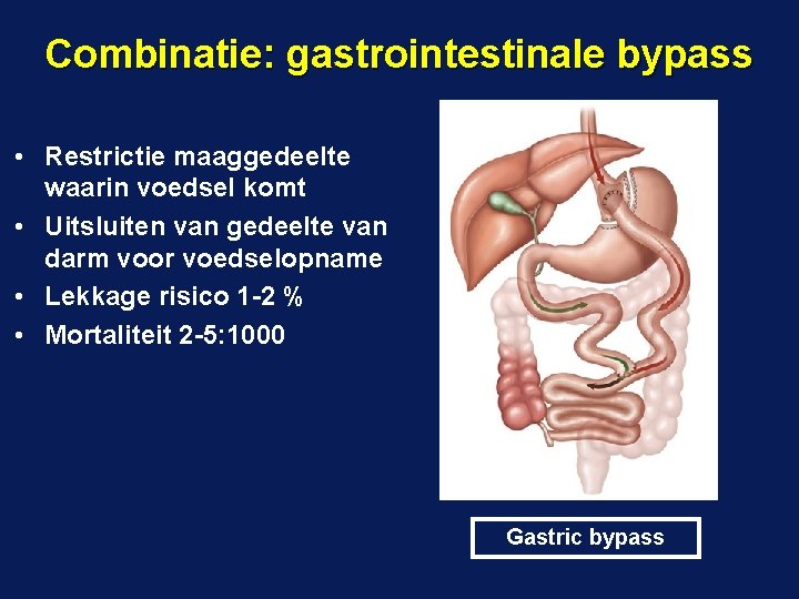 Combinatie: gastrointestinale bypass • Restrictie maaggedeelte waarin voedsel komt • Uitsluiten van gedeelte van