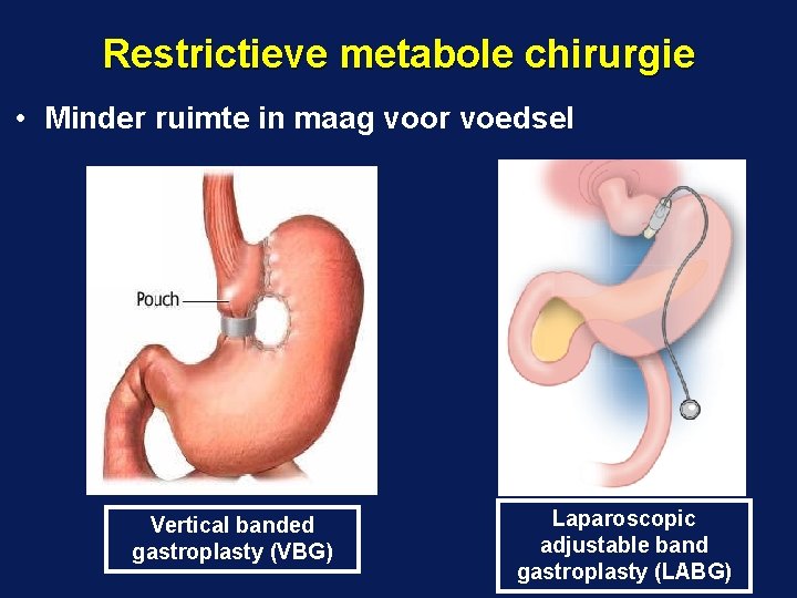 Restrictieve metabole chirurgie • Minder ruimte in maag voor voedsel Vertical banded gastroplasty (VBG)