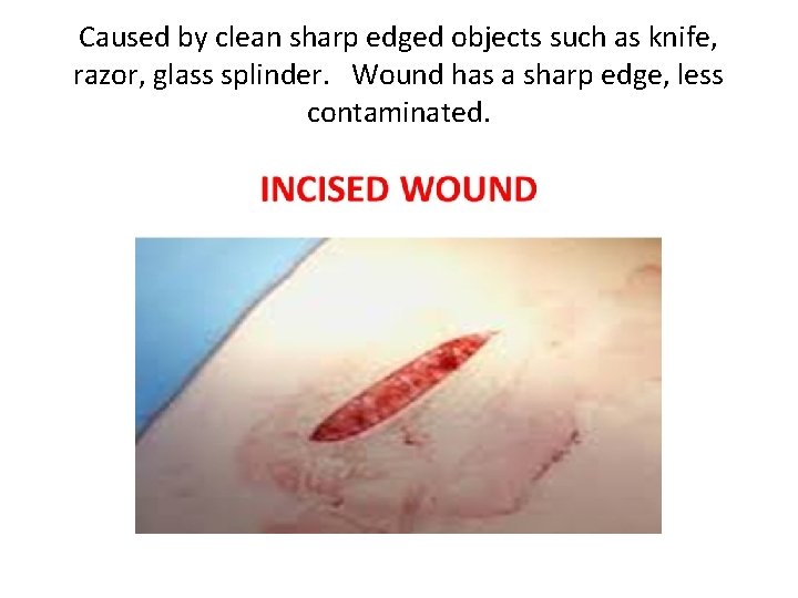 Caused by clean sharp edged objects such as knife, razor, glass splinder. Wound has