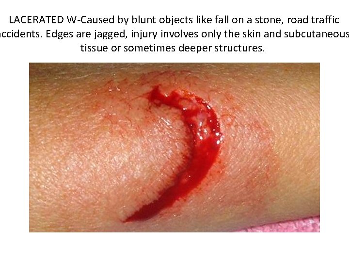  LACERATED W-Caused by blunt objects like fall on a stone, road traffic accidents.