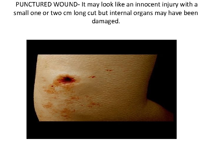  PUNCTURED WOUND- It may look like an innocent injury with a small one