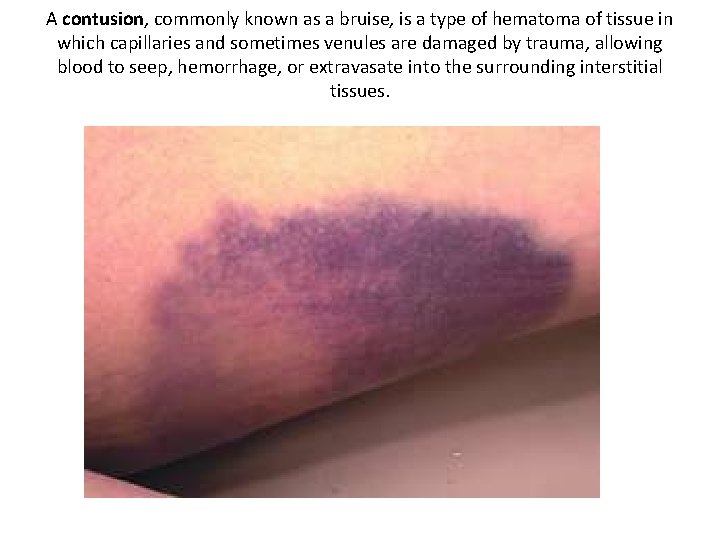 A contusion, commonly known as a bruise, is a type of hematoma of tissue