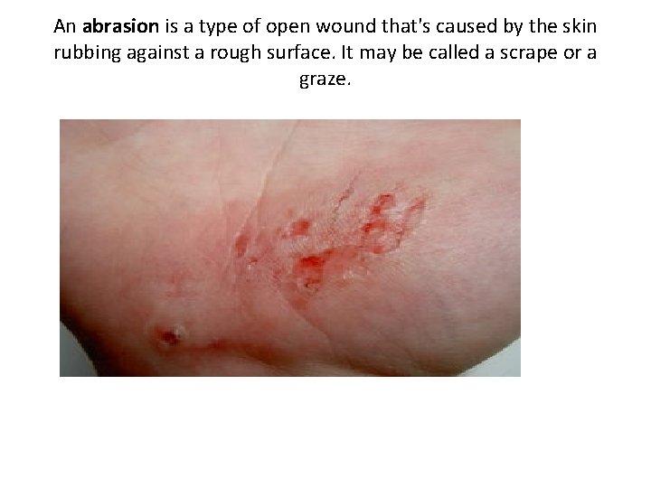 An abrasion is a type of open wound that's caused by the skin rubbing