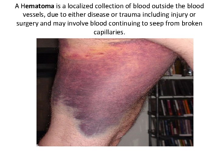 A Hematoma is a localized collection of blood outside the blood vessels, due to