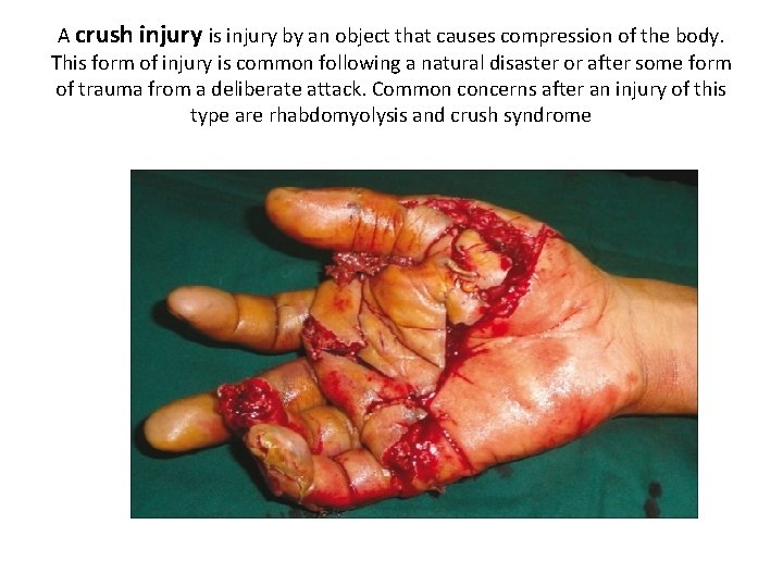 A crush injury is injury by an object that causes compression of the body.