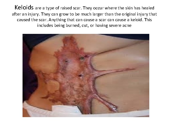 Keloids are a type of raised scar. They occur where the skin has healed