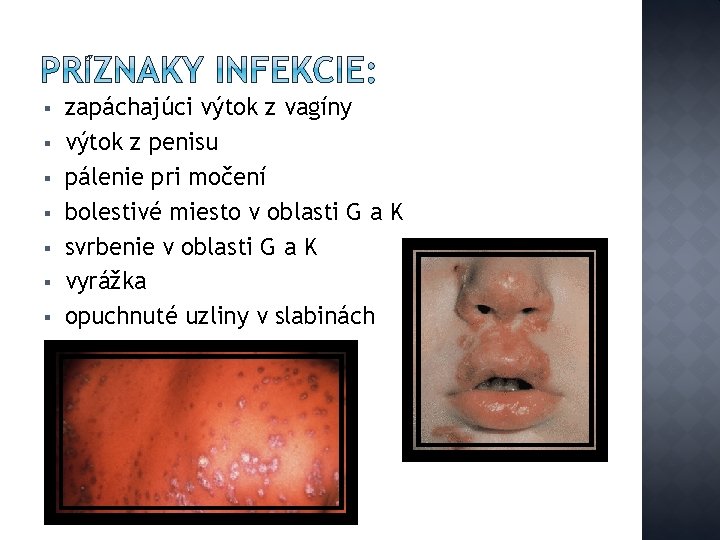 § § § § zapáchajúci výtok z vagíny výtok z penisu pálenie pri močení