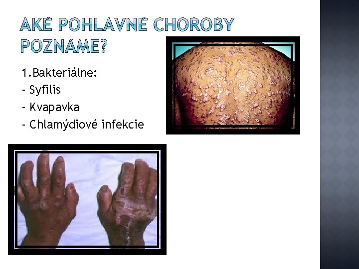 1. Bakteriálne: - Syfilis - Kvapavka - Chlamýdiové infekcie 