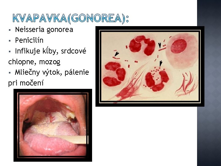 Neisseria gonorea § Penicilín § Infikuje kĺby, srdcové chlopne, mozog § Mliečny výtok, pálenie