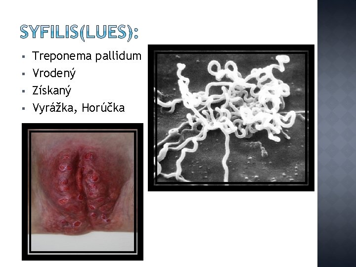 § § Treponema pallidum Vrodený Získaný Vyrážka, Horúčka 