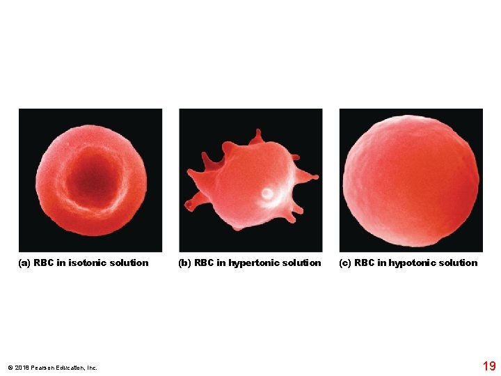 (a) RBC in isotonic solution © 2018 Pearson Education, Inc. (b) RBC in hypertonic