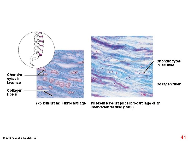 Chondrocytes in lacunae Collagen fibers (c) Diagram: Fibrocartilage © 2018 Pearson Education, Inc. Photomicrograph: