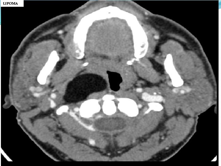 LIPOMA 