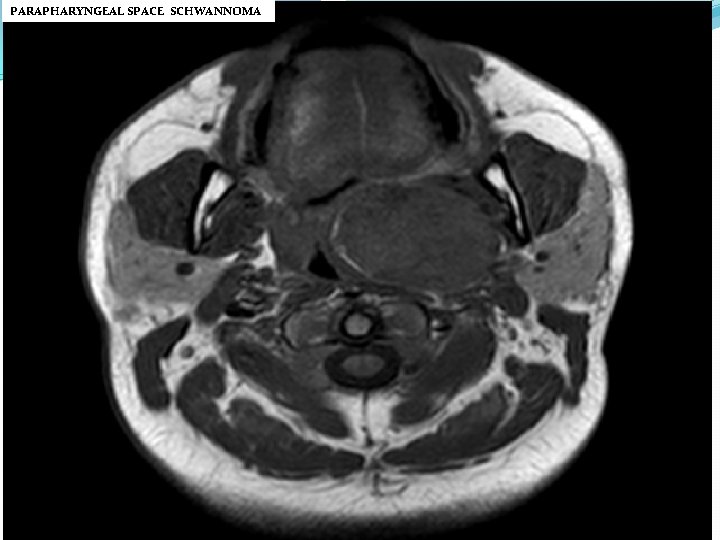 PARAPHARYNGEAL SPACE SCHWANNOMA 