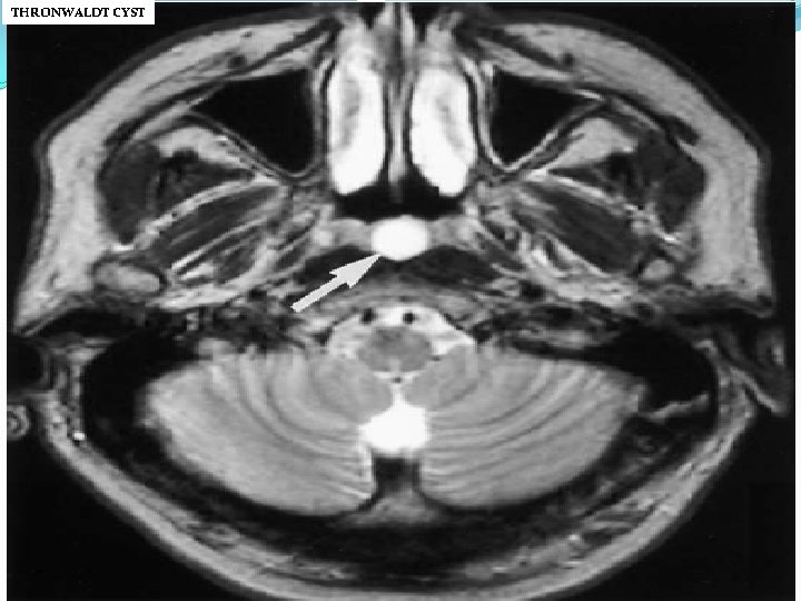 THRONWALDT CYST 