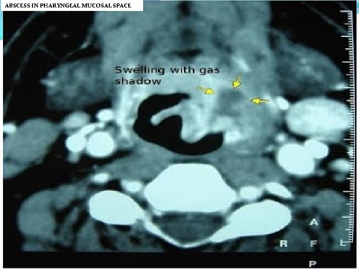 ABSCESS IN PHARYNGEAL MUCOSAL SPACE 