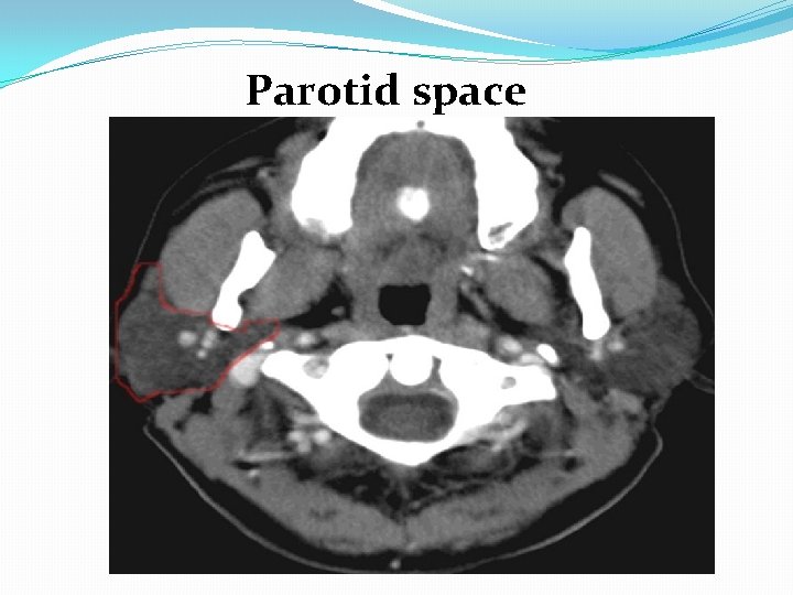  Parotid space 