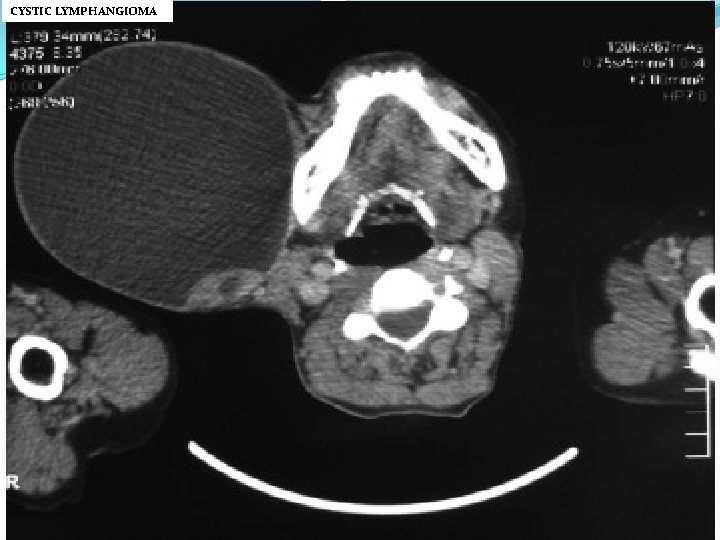 CYSTIC LYMPHANGIOMA 