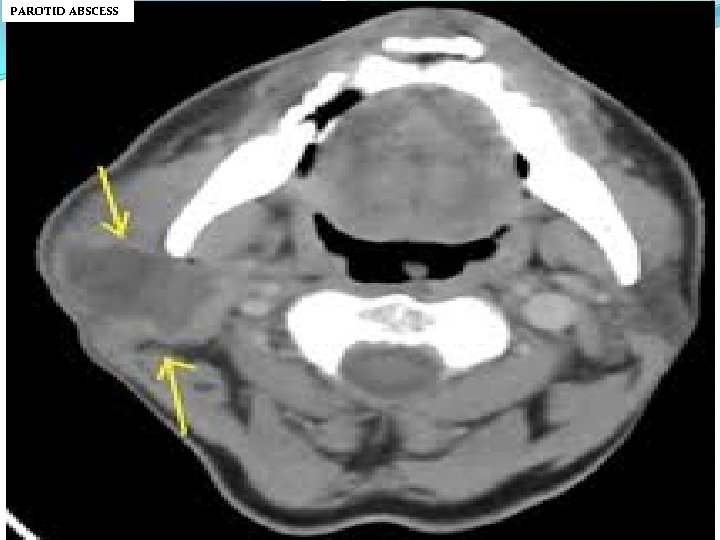 PAROTID ABSCESS 