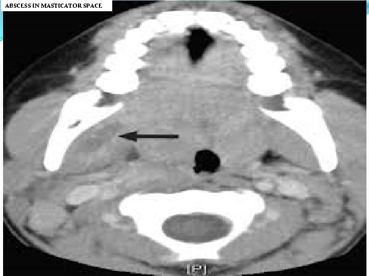 ABSCESS IN MASTICATOR SPACE 