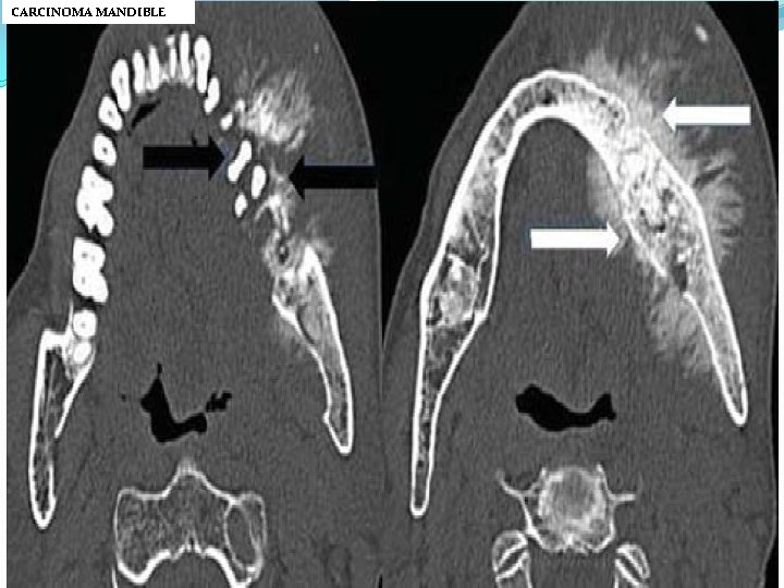 CARCINOMA MANDIBLE 