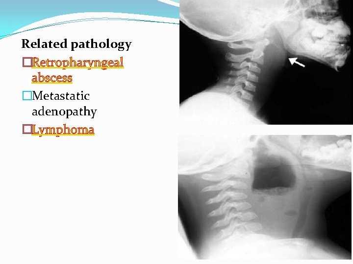 Related pathology �Retropharyngeal abscess �Metastatic adenopathy �Lymphoma 