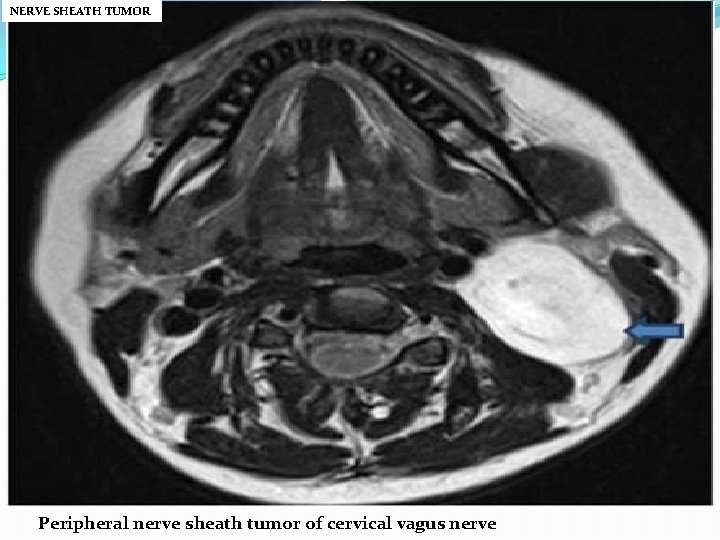NERVE SHEATH TUMOR Peripheral nerve sheath tumor of cervical vagus nerve 