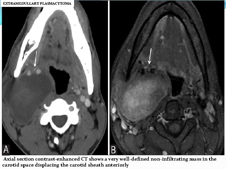 EXTRAMEDULLARY PLASMACYTOMA Axial section contrast-enhanced CT shows a very well-defined non-infiltrating mass in the