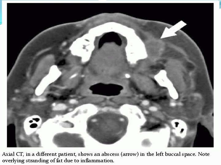 Axial CT, in a different patient, shows an abscess (arrow) in the left buccal