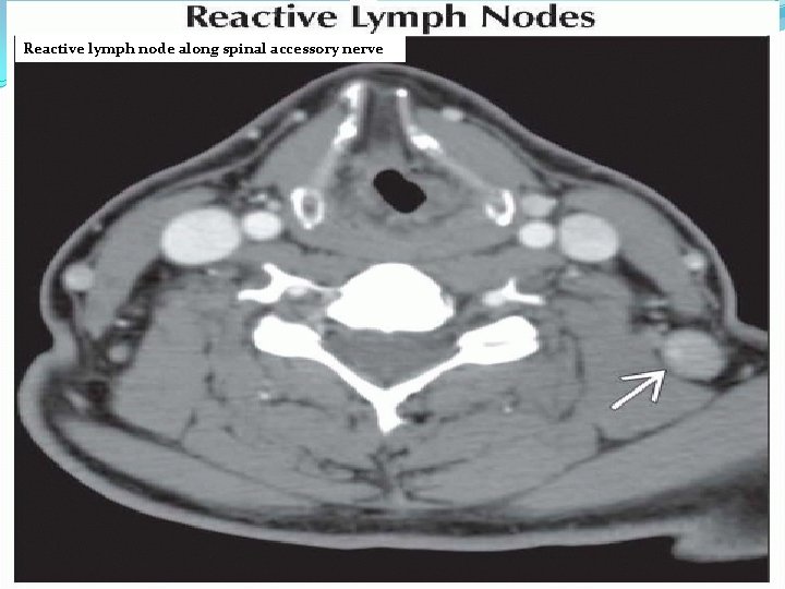 Reactive lymph node along spinal accessory nerve 