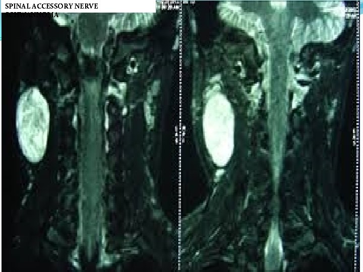 SPINAL ACCESSORY NERVE SCHWANNOMA 