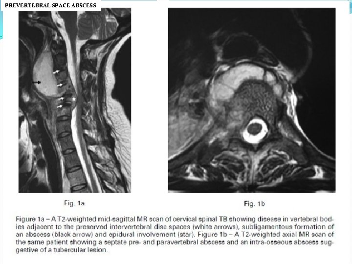 PREVERTEBRAL SPACE ABSCESS 