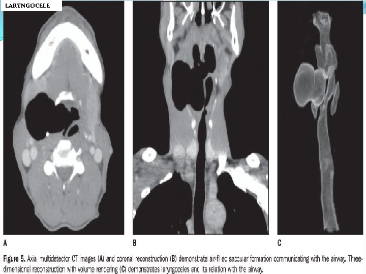 LARYNGOCELE 